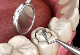 Diş Dolgusu Nedir? Ne Zaman Uygulanır ?